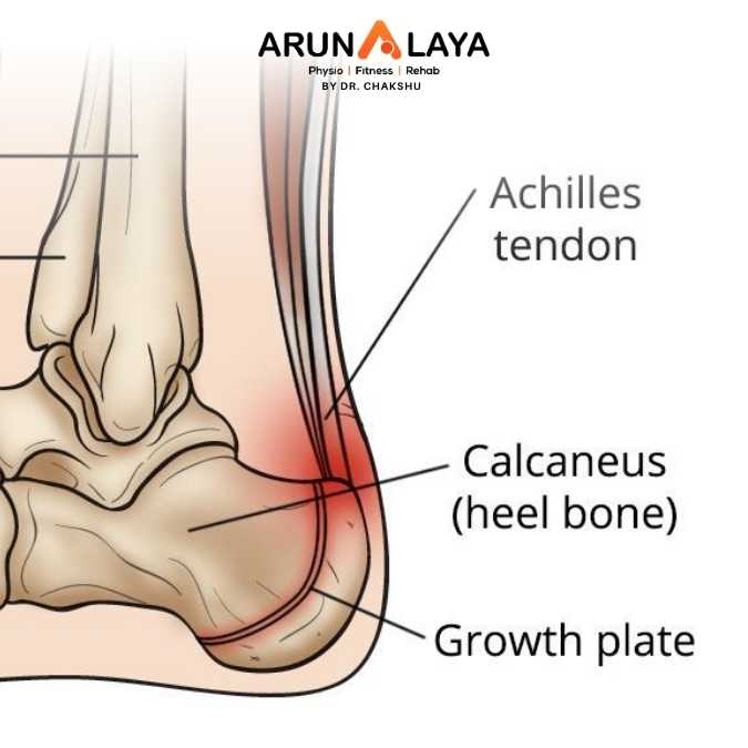 Sever Disease Scientific Yoga treatment and cure