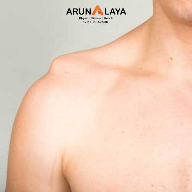 Shoulder separation treatment and cure