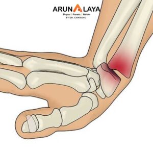Smith's Fracture treatment and cure