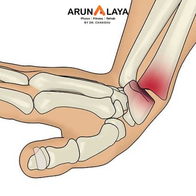 Smith's Fracture treatment and cure