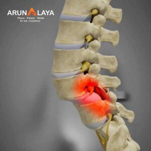 spondylolisthesis treatment at Arunalaya