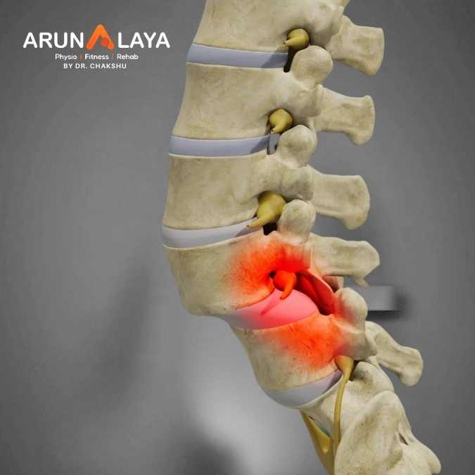 spondylolisthesis treatment at Arunalaya