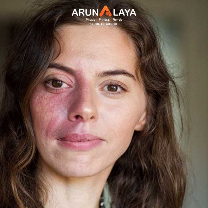 Sturge-Weber Syndrome treatment and cure