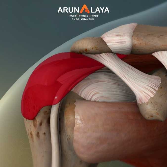 Subacromial tendonitis treatment and cure