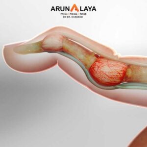 Swan-Neck Deformity treatment and cure