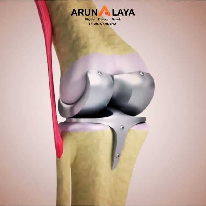 TKR treatment and cure