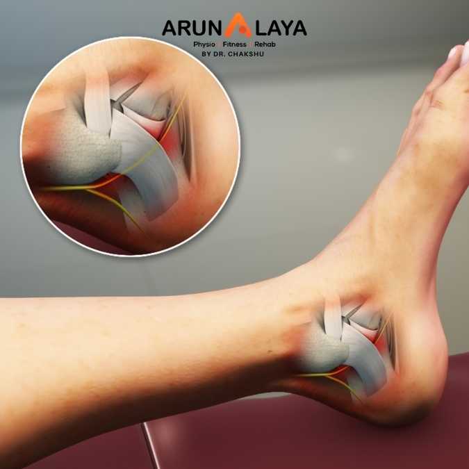 Tarsal Tunnel Syndrome treatment and cure