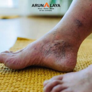 The Diabetic Foot treatment and cure