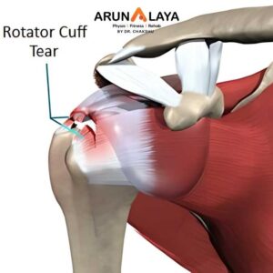Torn rotator cuff treatment and cure