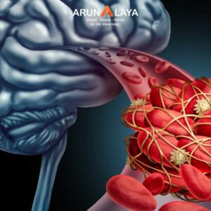 Transient ischemic attack treatment and cure