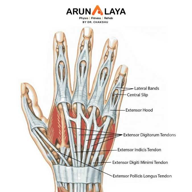 Traumatic Extensor Hood Rupture treatment and cure