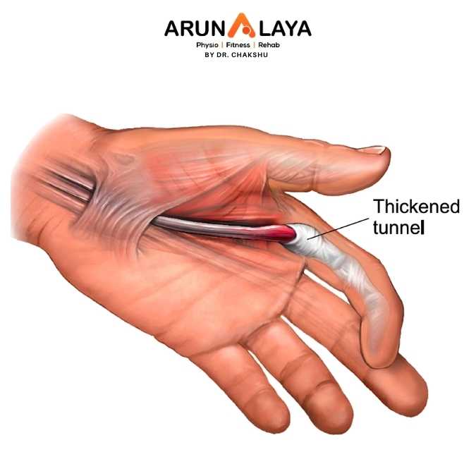 Trigger Finger treatment and cure