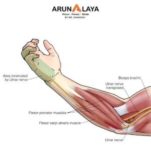 Ulnar Nerve Entrapment treatment and cure