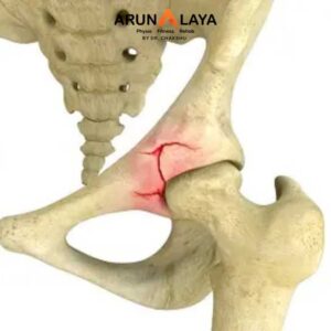 acetabular fracture treatment and cure
