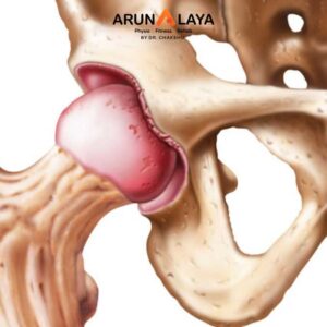 acetabular labral tear treatment and cure