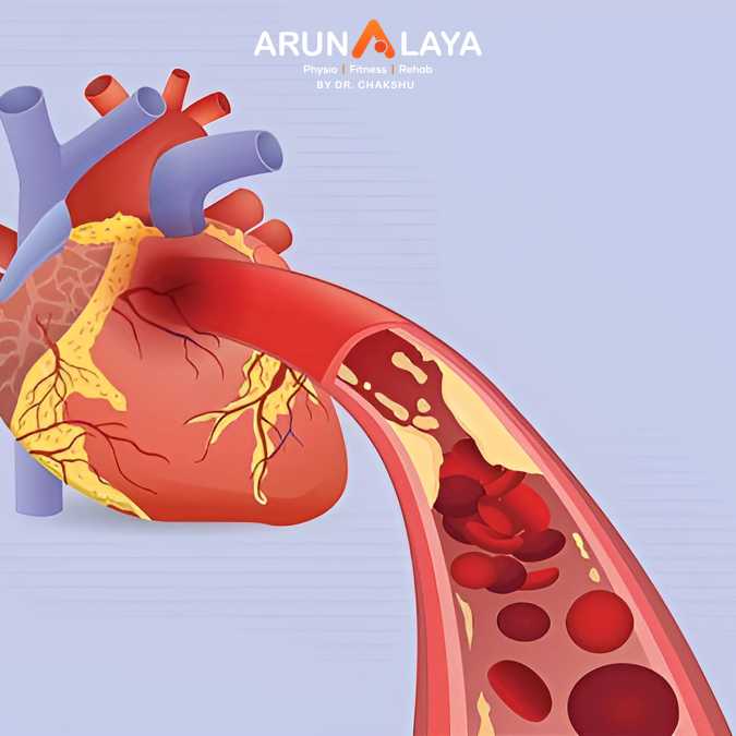acute coronary artery syndrome treatment and cure