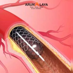 after a percutaneous coronary intervention treatment and cure
