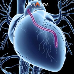 after coronary artery bypass surgery treatment and cure