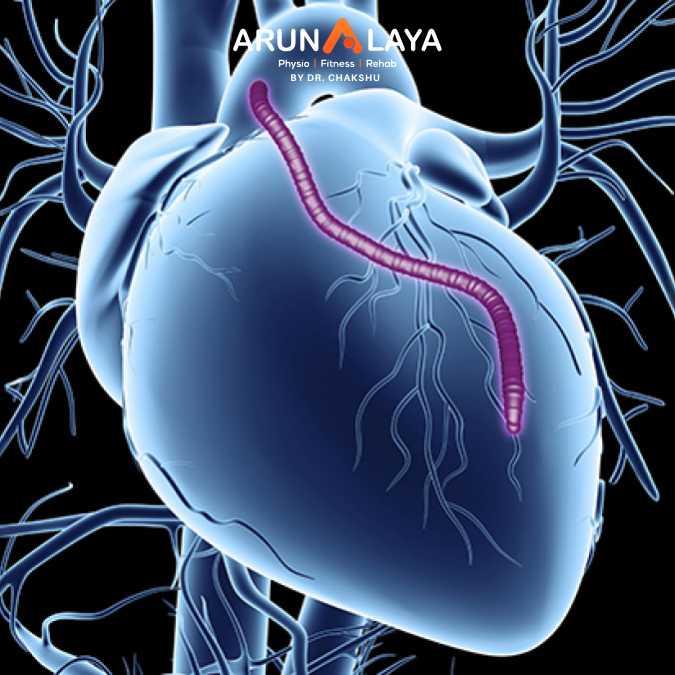 after coronary artery bypass surgery treatment and cure