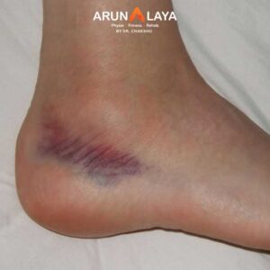ankle sprain treatment and cure