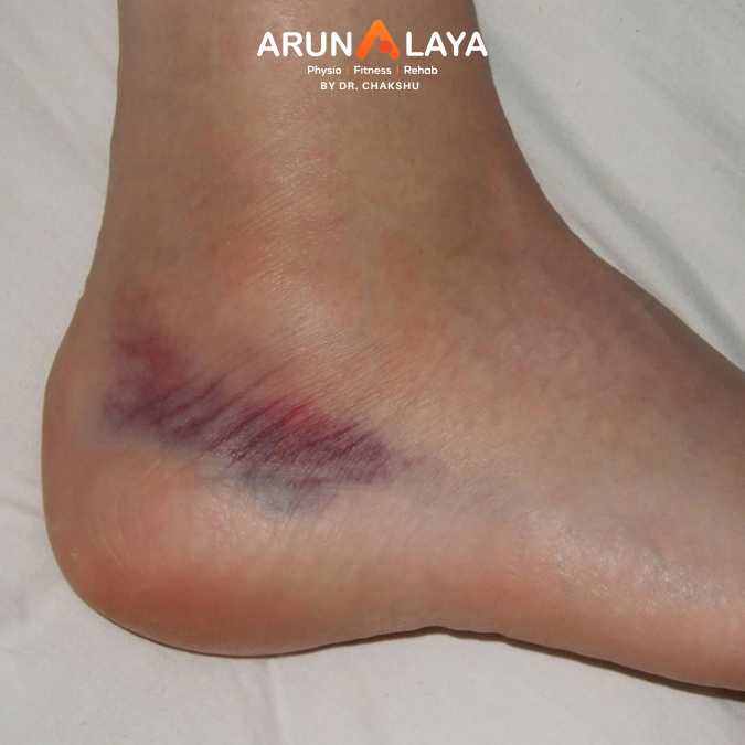ankle sprain treatment and cure