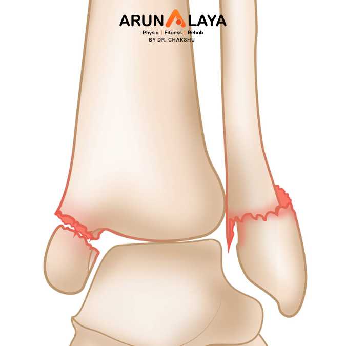 avulsion fractures of ankle treatment and cure