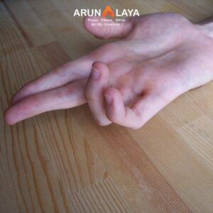 claw hand treatment and cure