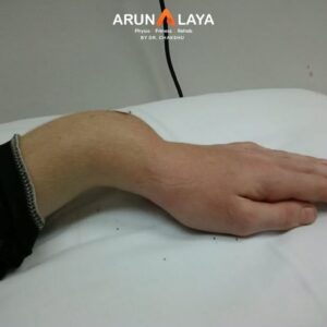 colles fracture treatment and cure