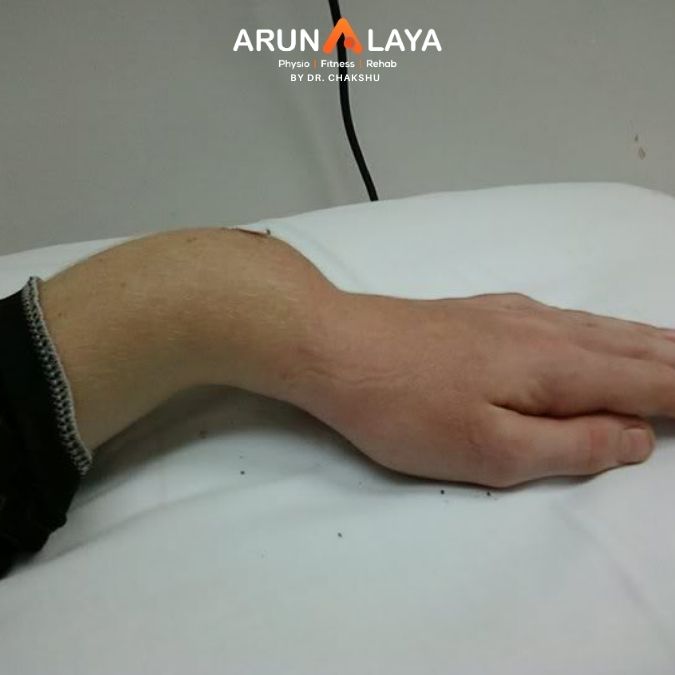 colles fracture treatment and cure