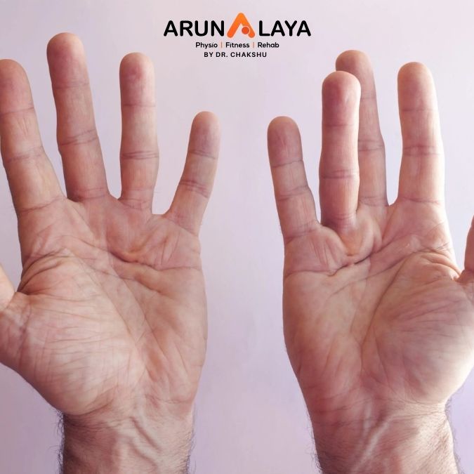 dupuytren's contracture treatment and cure