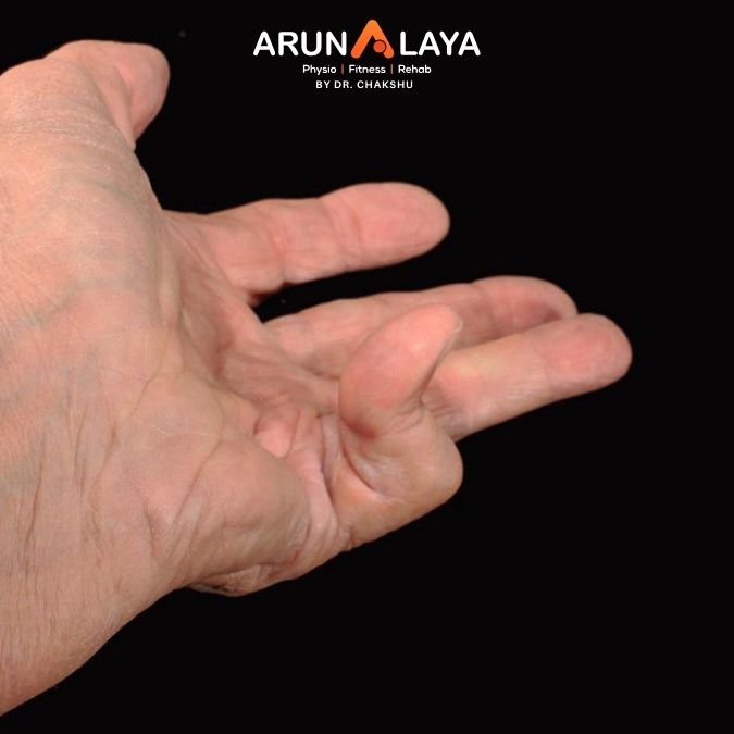 dupuytren's fracture treatment and cure