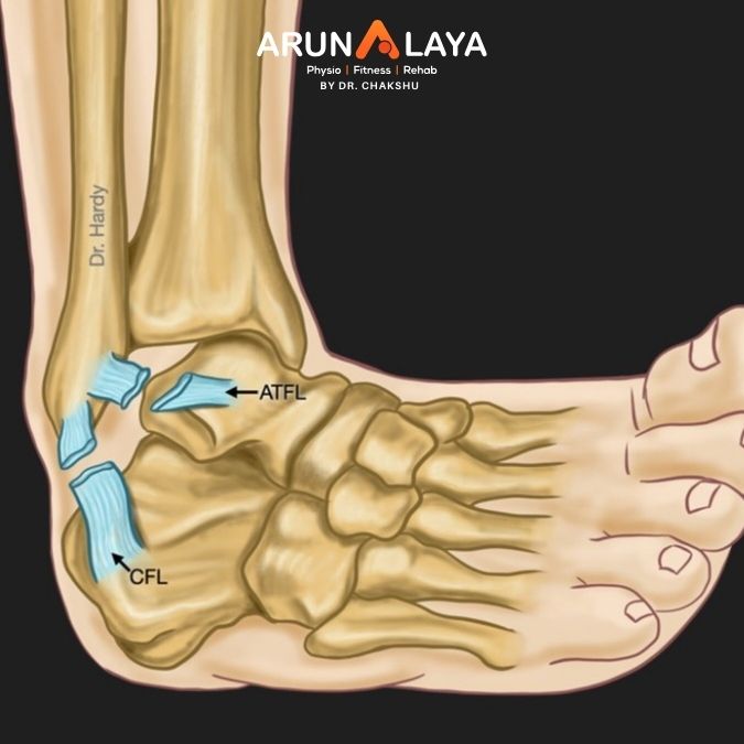 ligament sprain treatment and cure