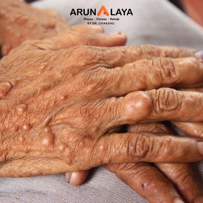 neurofibromatosis treatment and cure