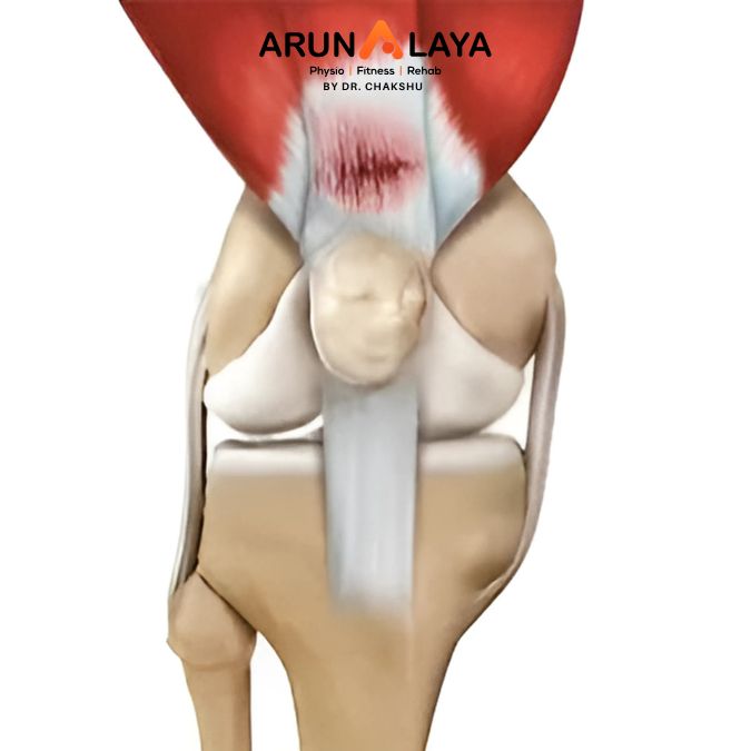 overstretched muscle tendon treatment and cure