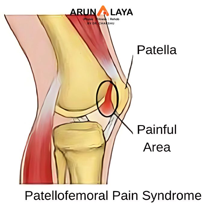 patellofemoral pain syndrome treatment and cure