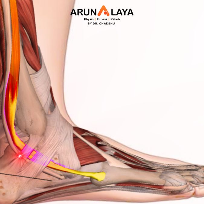 Peroneal Tendon Subluxation treatment and cure
