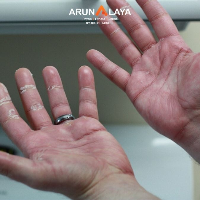 plantar fascitis treatment and cure