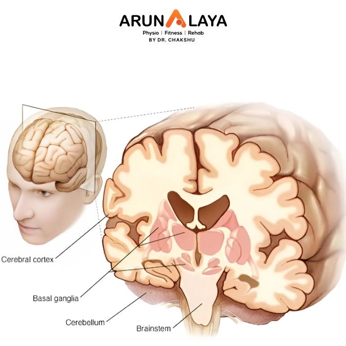 Progressive Supranuclear Palsy