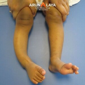 Pseudoarthrosis Physiotherapy