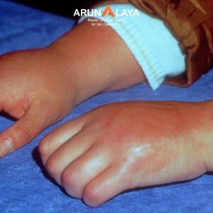 reflex sympathetic dystrophy treatment and cure