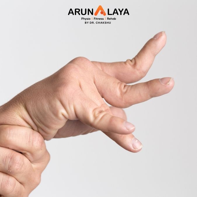 rigidity Physiotherapy and cure