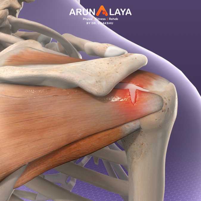 rotator cuff tendinitis treatment and cure