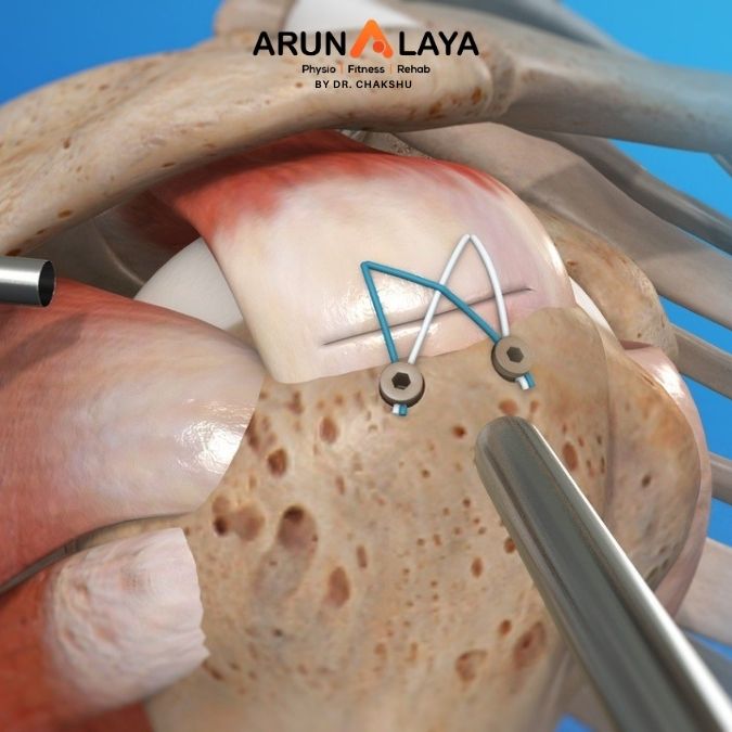 shoulder arthroscopy treatment and cure