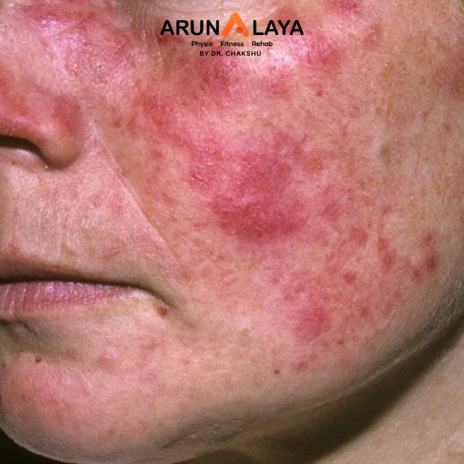 Systemic Lupus Erythematosus(SLE)