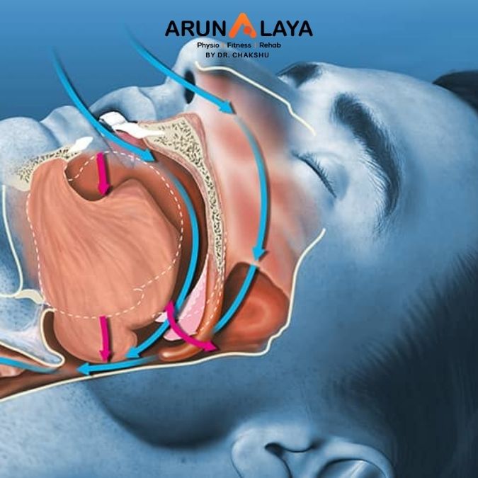 sleep apnea treatment and cure