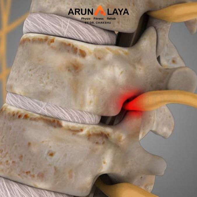spondylosis treatment