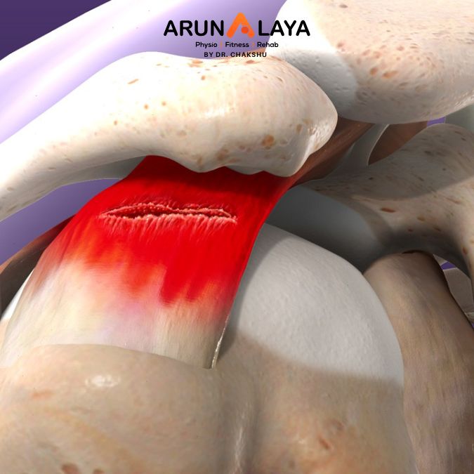 supraspinatus tear treatment and cure