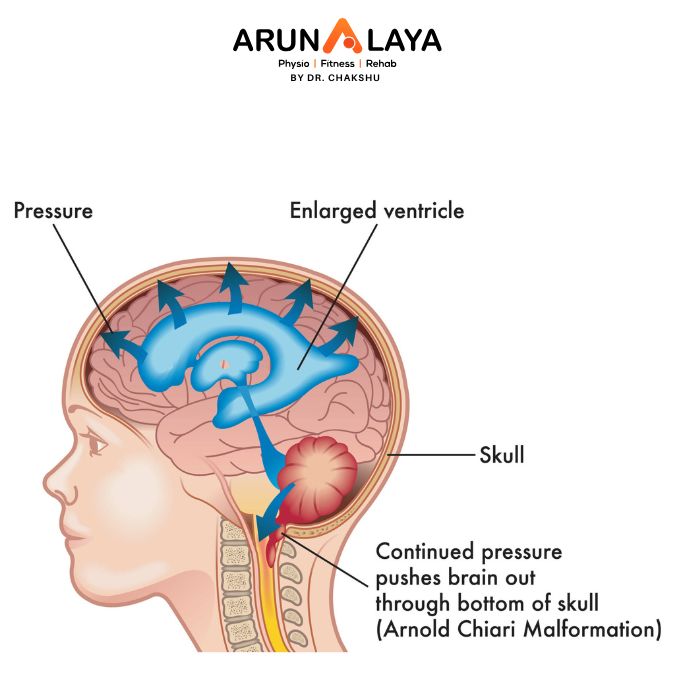 syringomyelia treatment and cure