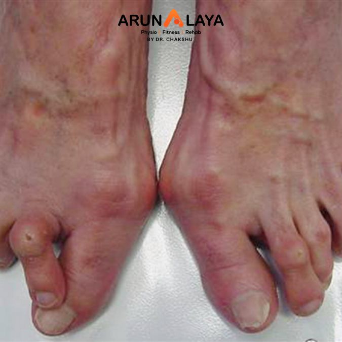 tabes dorsalis treatment and cure