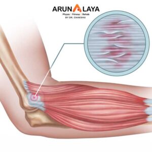tendinopathy treatment and cure